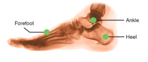 Why do I have heel pain?