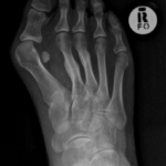 Why Do You Get Bunions, Dr Praven Reddy