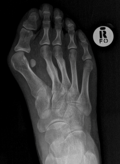 Why Do You Get Bunions, Dr Praven Reddy